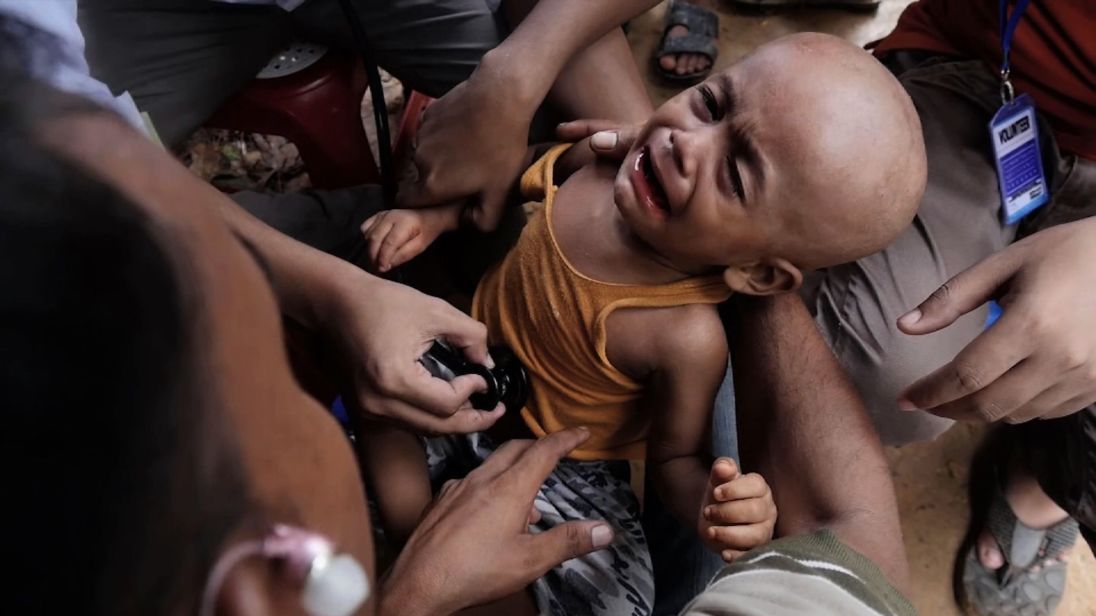  Yaseem souffre de malnutrition et d'une infection du cuir chevelu 