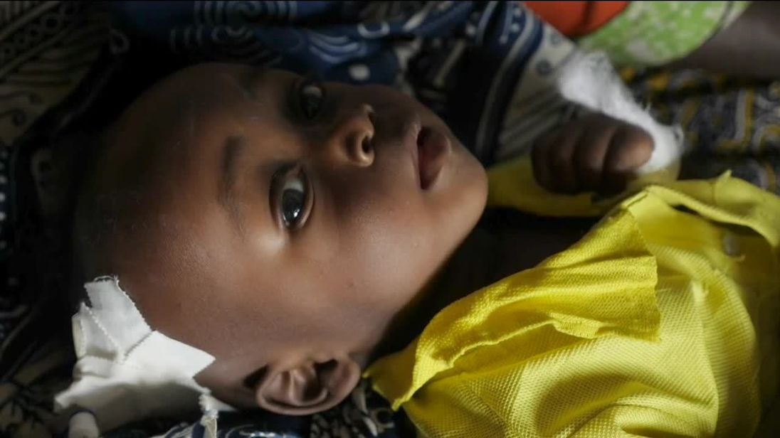  Un enfant sévèrement mal nourri en République démocratique du Congo 