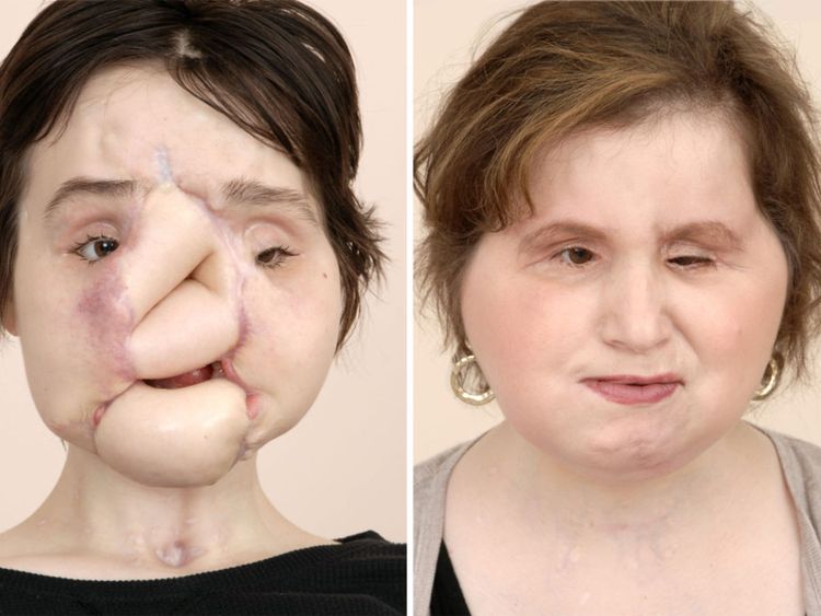Mme Stubblefield a subi plusieurs chirurgies avant sa transplantation Pic: Clinique de Cleveland