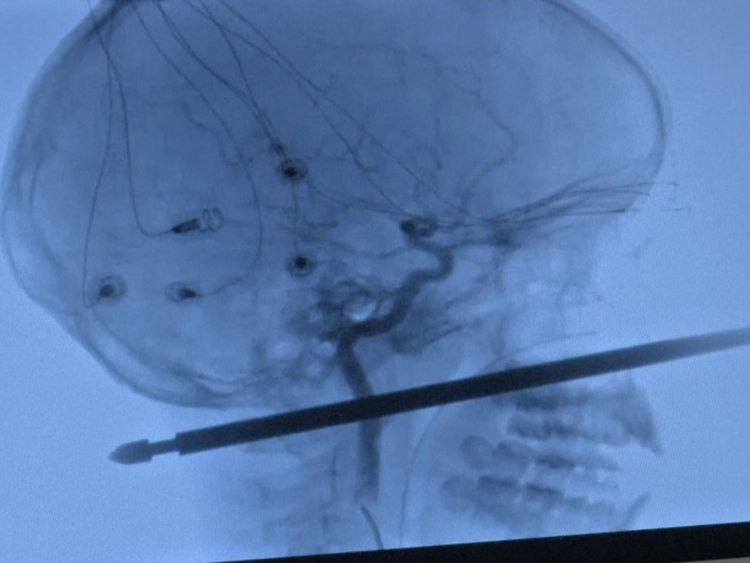 Plus de 100 membres du personnel médical ont été impliqués dans l'intervention chirurgicale de Xavier. Pic: Réseau de nouvelles médicales