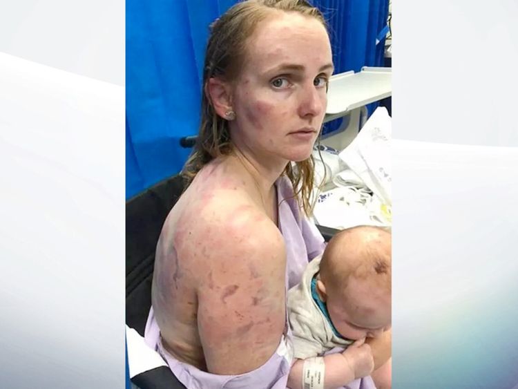Fiona Simpson est restée couverte de bleus. Pic: Facebook
