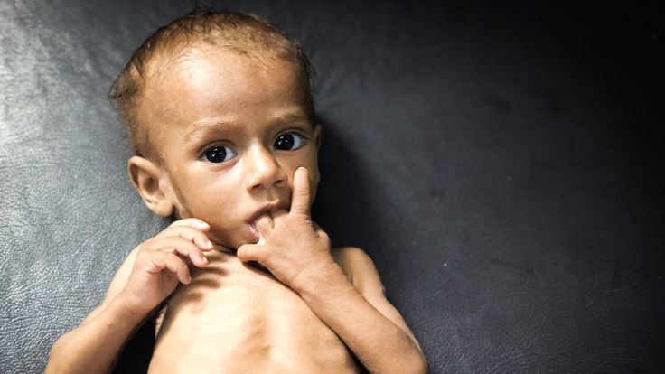 Nusair, victime de malnutrition aidée par Save The Children
