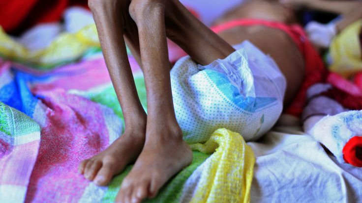 Les enfants sont particulièrement vulnérables à la malnutrition dans le conflit au Yémen, comme cet enfant de Sanaa la semaine dernière.