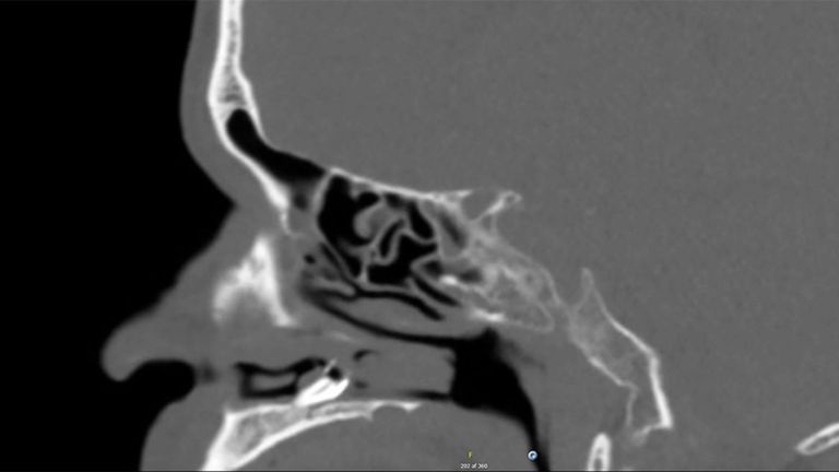Scanner réalisé par les médecins avant l'extraction. Pic: Rapports de cas BMJ