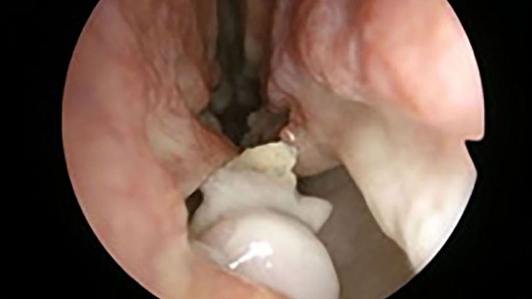 Photo prise par un endoscope de la dent avant son extraction. Pic: Rapports de cas BMJ