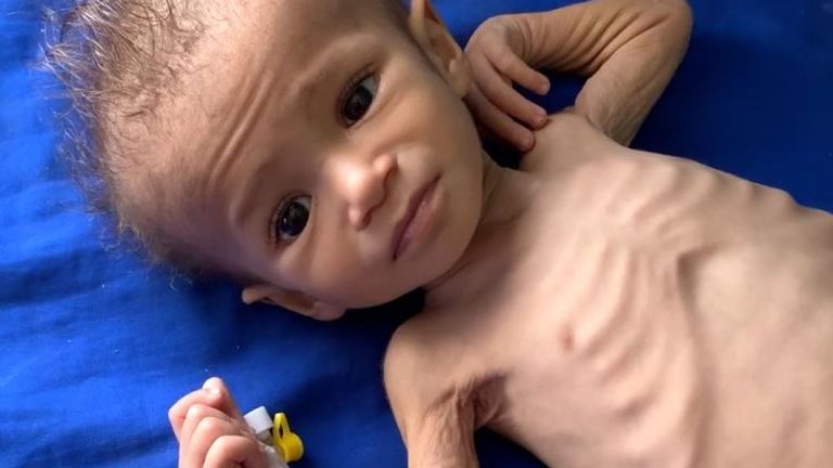 Bashira, âgée de 17 mois, ne pèse que 4 kg, contre 9 kg à son âge