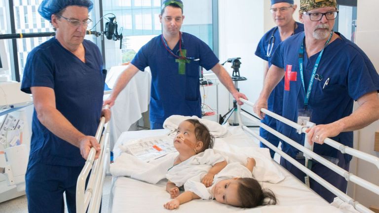 Les jumeaux ont été opérés en Australie. Pic: Fondation Enfants d'abord