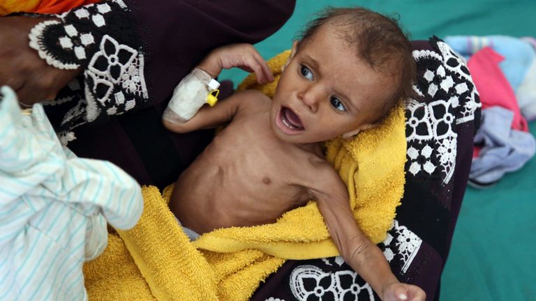 Un enfant yéménite souffre de malnutrition 