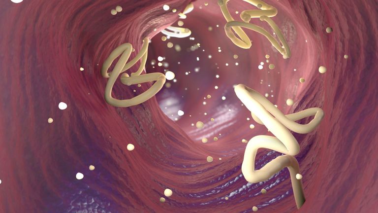 Illustration d'une infestation de ver solitaire dans un intestin humain