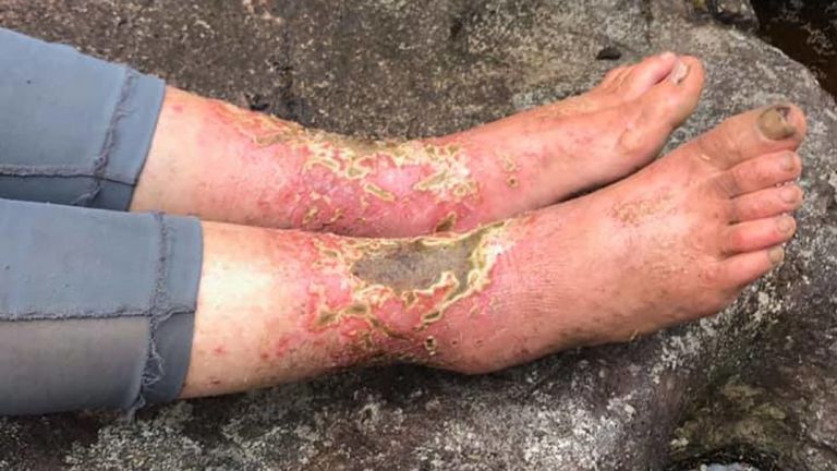 Les pieds d'Amanda après deux semaines manquantes à Maui. Pic: Javier Cantellops