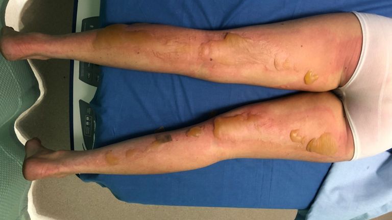 Mme Lee a partagé plusieurs photos du processus de récupération. Pic: GoFundMe