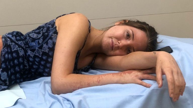Robyn Lee a subi des brûlures aux jambes, aux hanches, au dos et au bras droit. Pic: GoFundMe