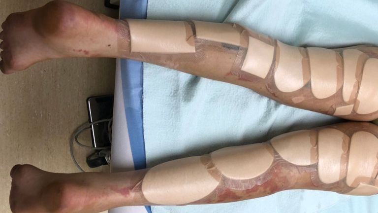 L'étudiante a décrit son épreuve comme un "enfer vivant". Pic: GoFundMe