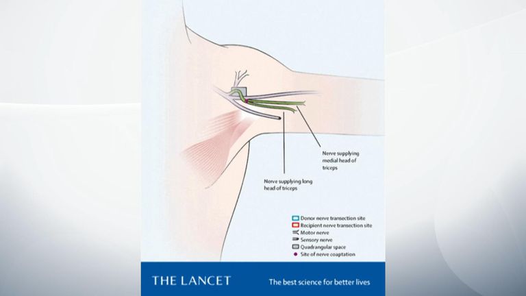 Les nerfs qui travaillaient ont pu se réanimer. le muscle précédemment paralysé. Pic: Le Lancet
