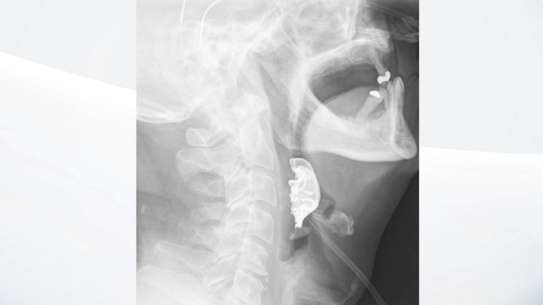 Une radiographie de la prothèse dentaire coincée dans la gorge du retraité. Pic: Fil BMJ / PA