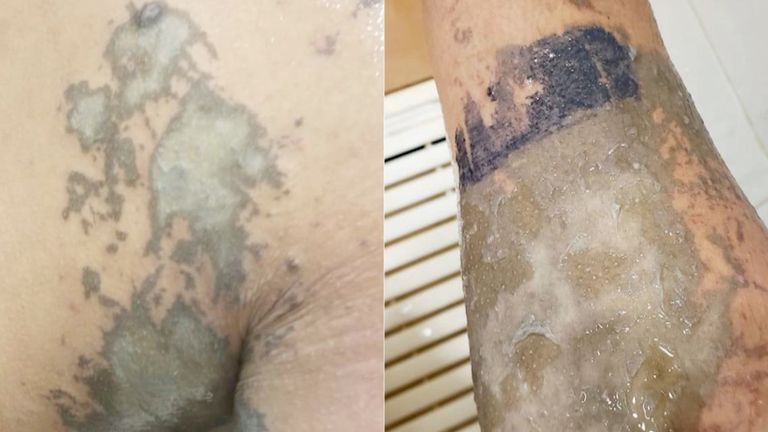 Les policiers disent qu'ils ont été ciblés avec un liquide corrosif