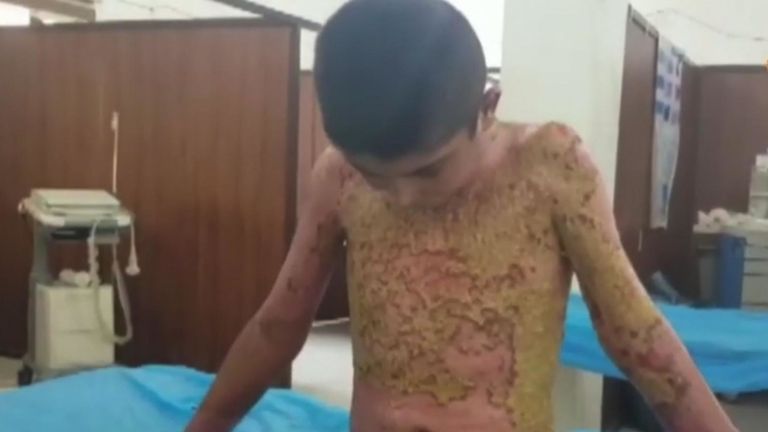 Des images montrent des enfants gravement brûlés en Syrie, alors que la Turquie utilise des armes chimiques interdites contre les Kurdes. 