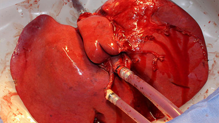 Un foie nouvellement traité qui a déjà été endommagé. Pic: USZ