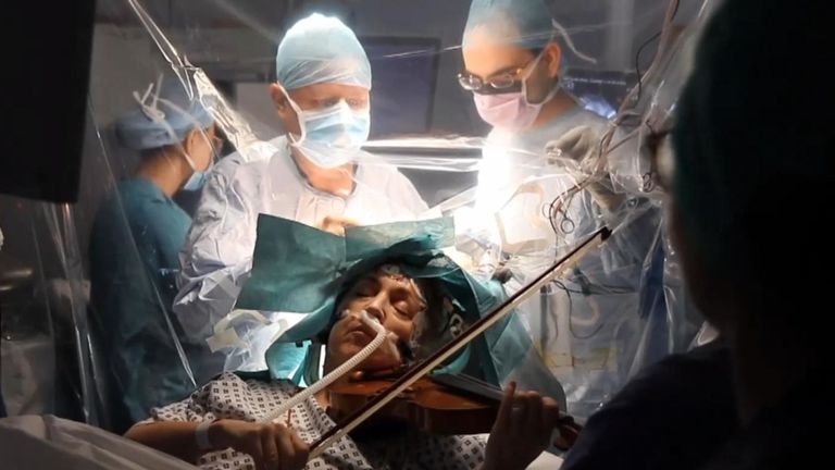 Un violoniste d’orchestre a joué de son instrument lors d’une opération visant à retirer une tumeur cérébrale au King’s College Hospital de Londres le 31 janvier, garantissant que le mouvement et la coordination de la main du musicien n’ont pas été accidentellement endommagés par les chirurgiens.