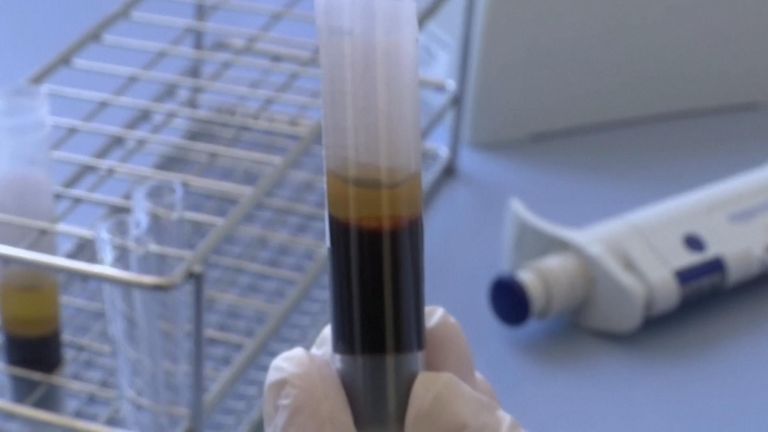 Utilisation de plasma hyper immunitaire pour traiter les patients COVID-19