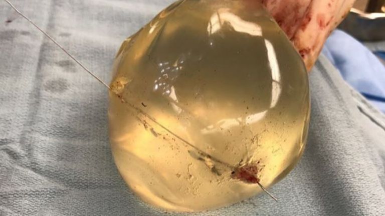Vue de l'implant mammaire gauche montrant la trajectoire de la balle à travers l'implant