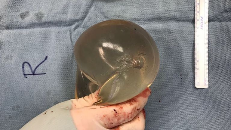 Vue de l'implant mammaire droit avec dommages causés par la trajectoire d'une balle
