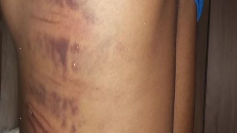 Vumani Mbele dit qu'il craint de se fracturer les côtes