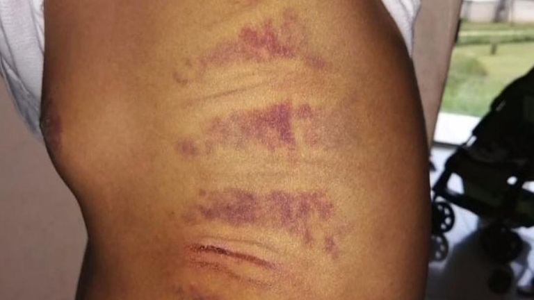 Vumani Mbele a été laissé & # 39; battu et meurtri & # 39; après que la police l'ait battu. Photo: Vumani Mbele