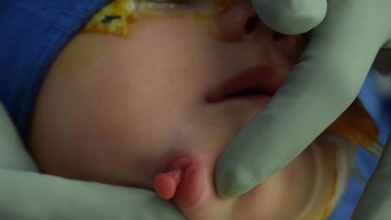 Le bébé pendant la procédure pour retirer la bouche en double. Photo: BMJ Journals