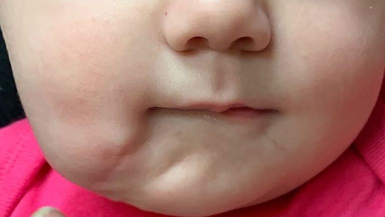 Après l'opération, l'enfant n'a pratiquement pas été touché. Photo: BMJ Journals