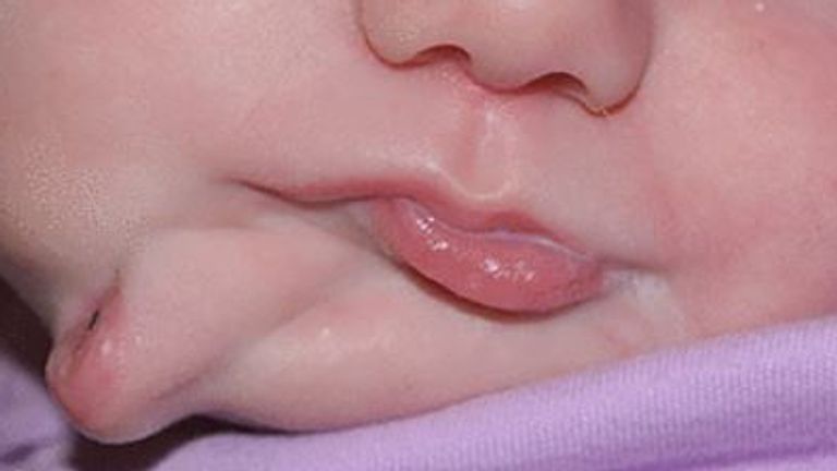 La cavité buccale supplémentaire comprend une lèvre, des dents et une langue supplémentaire. Photo: BMJ Journals