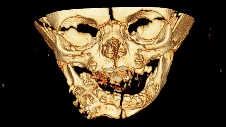 Une image aux rayons X de l'enfant. Photo: BMJ Journals