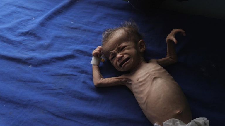 Yémen: bébé émacié, générique