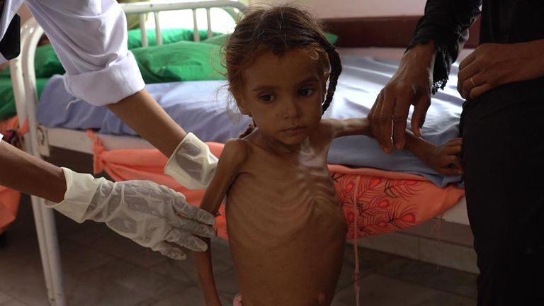 Yémen: un enfant émacié reçoit des soins à l'hôpital de Taiz