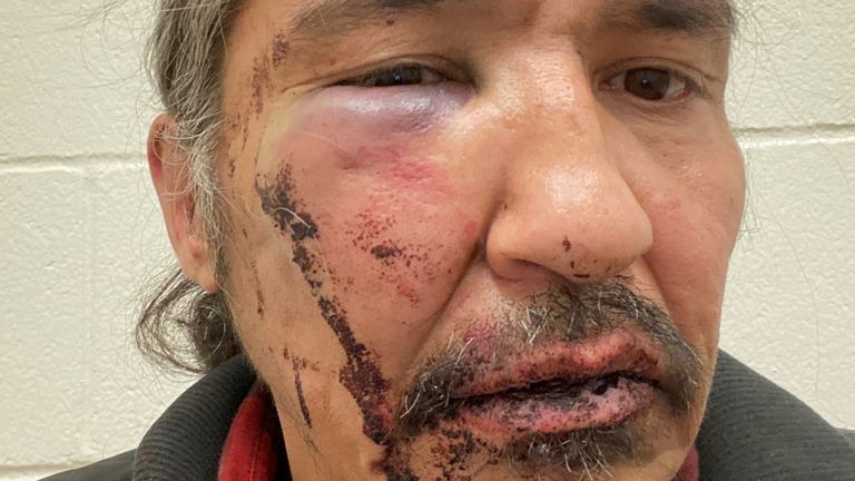 Le chef Allan Adam de la Première nation Athabasca Chipeywan affiche ses blessures qui, selon lui, ont été causées par des agents de la Gendarmerie royale du Canada (GRC) du détachement de Wood Buffalo lors d'un incident à Fort McMurray, Alberta, Canada, le 10 mars 2020. Photo prise le 10 mars 2020. 2020. Gracieuseté d'Allan Adam via REUTERS. PAS DE REVENTE. PAS D'ARCHIVES. CETTE IMAGE A ÉTÉ FOURNIE PAR UN TIERS. CETTE IMAGE A ÉTÉ TRAITÉE PAR REUTERS POUR AMÉLIORER LA QUALITÉ, UNE VERSION NON TRAITÉE A ÉTÉ FOURNIE SÉPARÉMENT.
Chef Alla