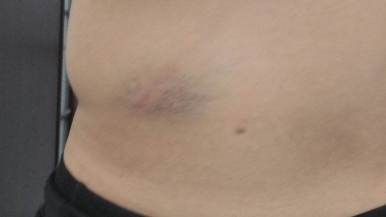 M. Kviatko avait des ecchymoses au dos d'où la police l'a battu