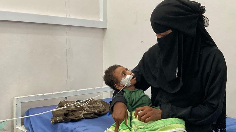 La malnutrition fait paraître Zaid Mohammed plus âgé que ses deux ans