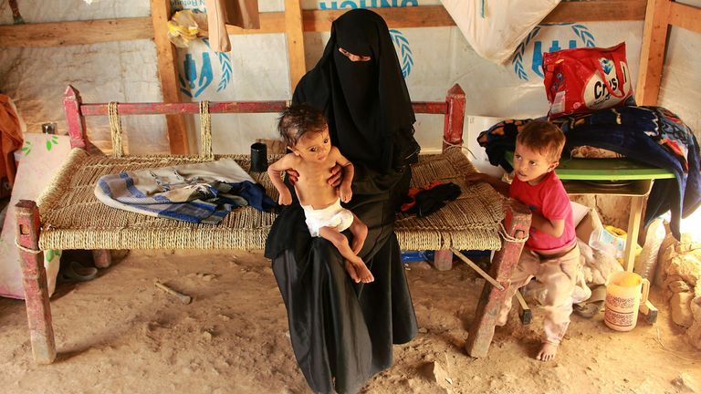 De nombreux enfants souffrent de malnutrition aiguë