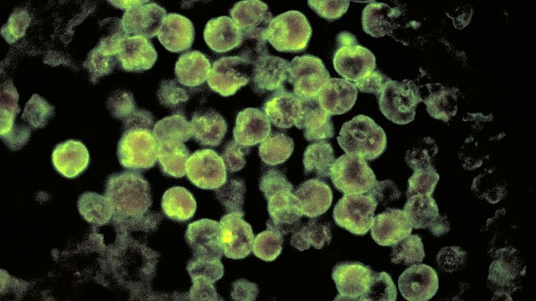 En utilisant la technique de coloration par anticorps fluorescent direct (DFA), cette photomicrographie décrit les caractéristiques histopathologiques associées à un cas de méningo-encéphalite amibienne due aux parasites Naegleria fowleri.  Naegleria fowleri infecte les personnes lorsque l'eau contenant l'amibe pénètre dans le corps par le nez.  Cela se produit généralement lorsque les gens vont nager ou plonger dans des endroits d'eau douce chaude, comme les lacs et les rivières.  La Naegleria fowleri ameba se déplace ensuite du nez jusqu'au cerveau où il de