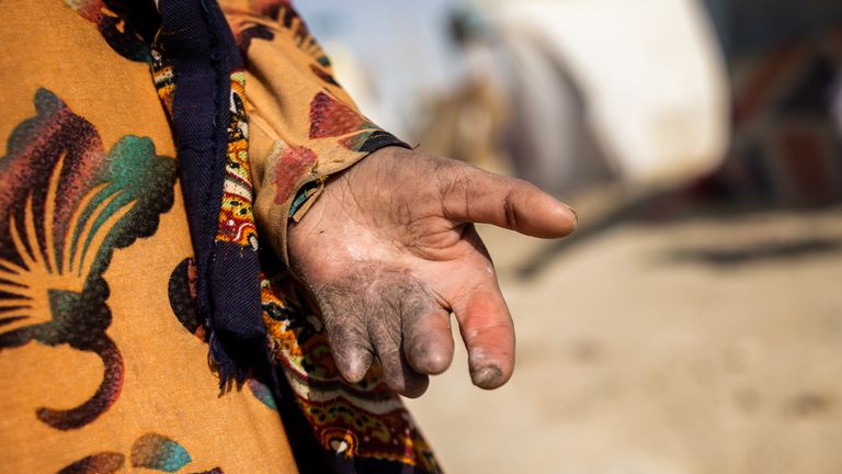 La main de Shogofa a été blessée lorsqu'une roquette a frappé sa maison.  Pic: Jim Huylebroek / Save The Children
