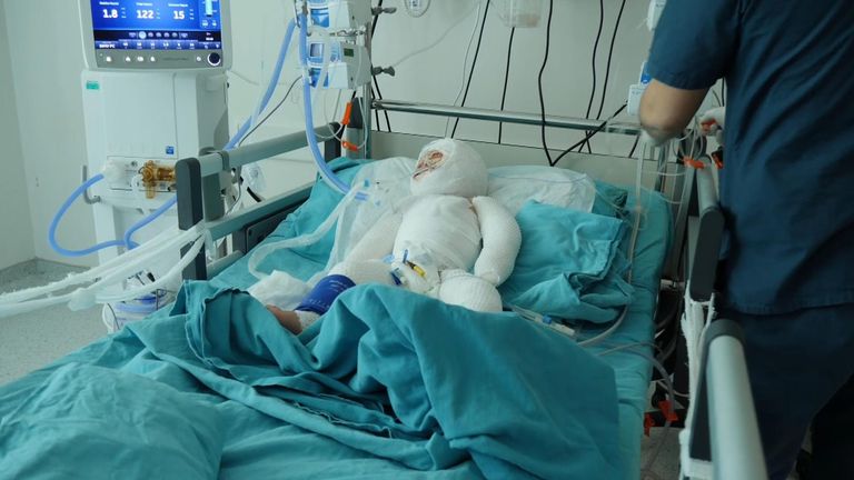 Dalal, 18 mois, a été gravement brûlé dans l'incendie d'une tente en Syrie