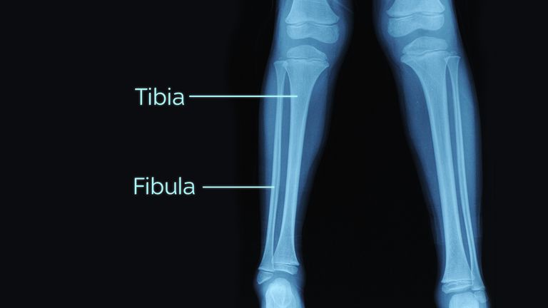 Les fractures ouvertes de Woods affectent à la fois les parties supérieure et inférieure des os du tibia et du péroné.  Image de fichier