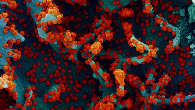 Micrographie électronique à balayage colorisée d'une cellule fortement infectée par des particules de virus SRAS-CoV-2 (rouge), isolée à partir d'un échantillon de patient.  Image capturée au centre de recherche intégré (IRF) du NIAID à Fort Detrick, Maryland